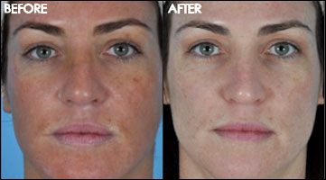 Chemical peels from a dermatologist